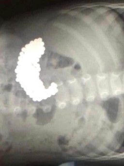 Bác sĩ sốc khi phát hiện 209 viên bi nam châm trong bụng bé trai 2 tuổi