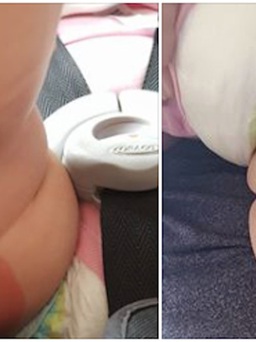 Sốc với hình ảnh em bé bị bỏng do mẹ đặt điện thoại vào xe đẩy