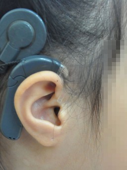 Phẫu thuật cấy ghép ốc tai điện tử cho trẻ bị khiếm thính khi nào?
