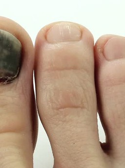 Có dấu hiệu này trên móng tay, móng chân, hãy kiểm tra ung thư ngay!