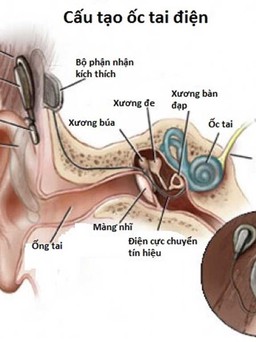Cấy ốc tai điện tử điều trị điếc bẩm sinh