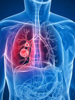 Người thuộc nhóm máu nào có nhiều nguy cơ ung thư phổi hơn?