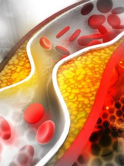 Chuyên gia: Cách ăn tốt nhất nếu bạn có mức cholesterol cao