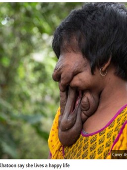 Xót xa cô gái 'không có khuôn mặt' ở Ấn Độ