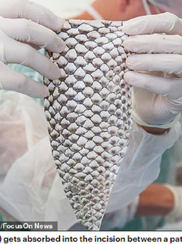 Phẫu thuật tái tạo âm đạo bằng da cá rô phi