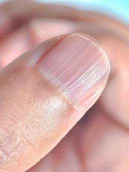 Một phụ nữ Mỹ bị nhiễm vi khuẩn 'ăn thịt người' khi làm móng tay