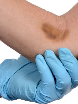 Bị bầm tím sau khi lấy máu hay tiêm vắc xin có sao không?
