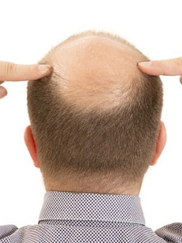 Loại thuốc mới giúp người rụng tóc mọc đến 80% tóc