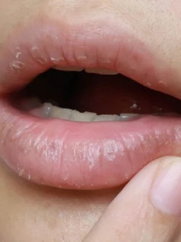 Góc miệng bị nứt có thể là triệu chứng của viêm môi, cách nào để mau khỏi?