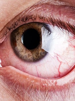 Đến bệnh viện khám, người đàn ông phát hiện hơn 10 con giòi trong mắt