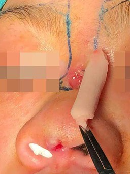 Sau nâng mũi tại spa, cây sụn silicon lòi ra trên mặt