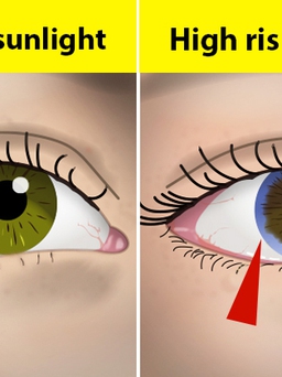 Nhìn đôi mắt có thể đoán được bệnh nghiêm trọng nào?