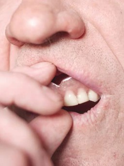 Càng rụng nhiều răng, nguy cơ bị suy giảm trí nhớ càng tăng