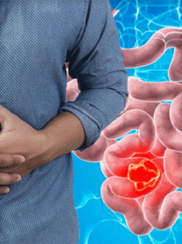 Gặp cả 3 triệu chứng này sau khi ăn, mau đi khám ung thư ruột!