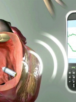 Smartphone làm rối loạn máy điều hòa nhịp tim