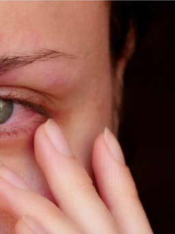Vì sao nhựa khoai môn có thể gây dị ứng, làm đau mắt?