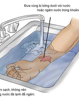 Hướng dẫn cách chăm sóc, điều trị sẹo bỏng