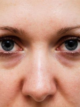 Thâm quầng mắt và 5 nguyên nhân phổ biến nhất