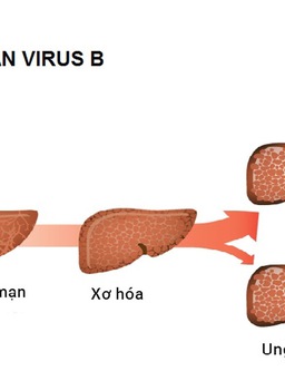 Cảnh báo biến chứng xơ gan do viêm gan virus