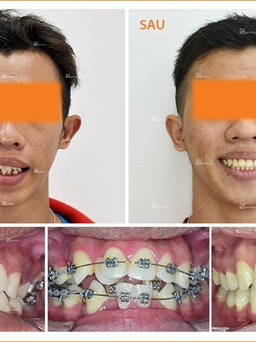 Vì sao răng bị hô, lệch lạc… nên niềng mắc cài kim loại?