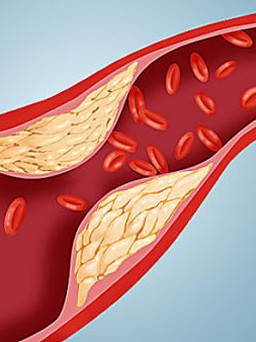 Thờ ơ với tình trạng thừa cholesterol, gần 50% người thành thị bị mỡ máu cao