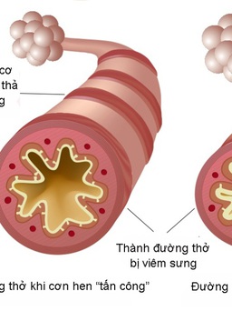 Giải pháp cải thiện ho, khò khè, khó thở