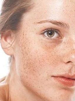 Tăng sắc tố da: Nguyên nhân, biểu hiện và cách điều trị hiệu quả