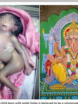 Đứa bé có 4 tay, 4 chân được tôn sùng ở Ấn Độ