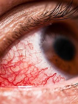 Virus gây xuất huyết ở mắt lan đến châu Âu, tỷ lệ tử vong đến 40%