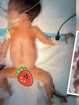 Tách bào thai ký sinh khỏi bé trai sinh ra với 4 tay, 4 chân