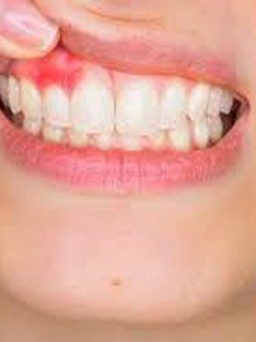 8 dấu hiệu bệnh răng miệng 'tố cáo' sức khỏe bạn đang có vấn đề