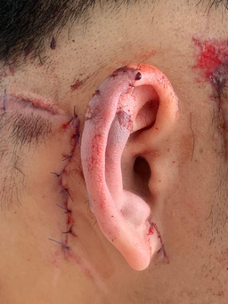 Bình Định: Nối thành công vành tai bị đứt gần lìa cho bệnh nhân