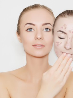 8 hỗn hợp tự nhiên giúp phái đẹp loại bỏ mụn