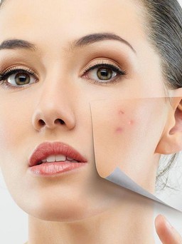 8 “chiến binh” siêu phàm giúp đánh bật các vấn đề về mụn