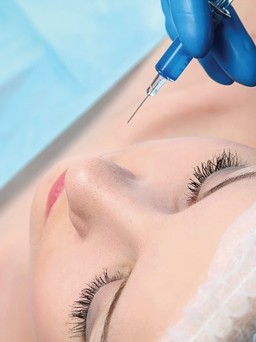 “Xe kim luồn chỉ” thành má lúm