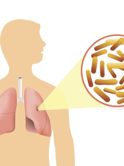 Chẩn đoán bệnh lao phổi
