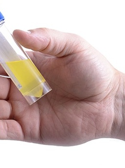 Chẩn bệnh từ màu sắc nước tiểu