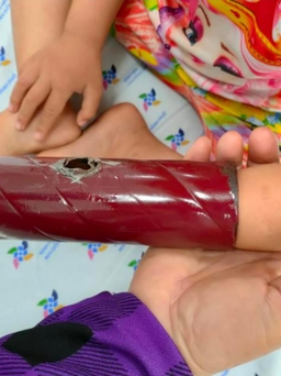 Bác sĩ ơi: Trẻ bị kẹt, dập tay chân, phải sơ cứu thế nào cho đúng?