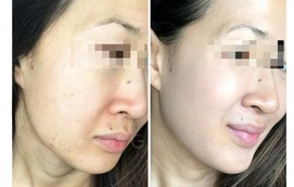 Liệu pháp peel da an toàn được chuyên gia tin tưởng, thay thế filler và botox