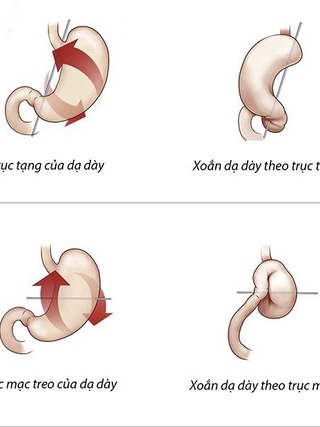 Bệnh xoắn dạ dày ở trẻ nhỏ