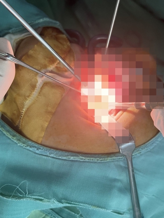 Kịp thời can thiệp trường hợp bị dị vật đâm vào xoang
