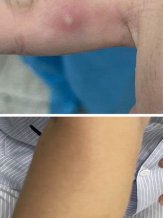 2 bệnh nhân đậu mùa khỉ đang cách ly, điều trị
