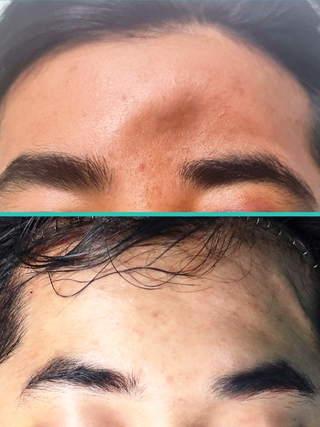 Tái tạo khuôn mặt bình thường cho bệnh nhân bị lõm xương trán