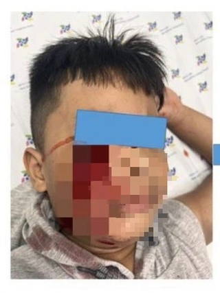 Đang chơi đùa, bé trai 5 tuổi bị chó cắn rách mặt