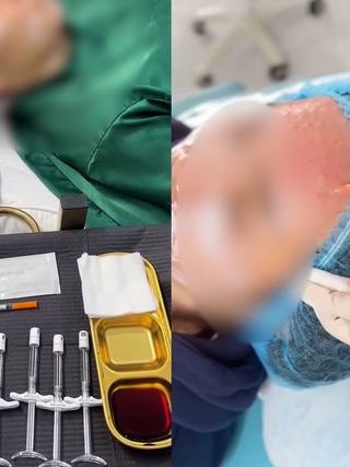 Thẩm mỹ 'chui' bủa vây: Cận cảnh quy trình làm đẹp không phép tại Đà Nẵng