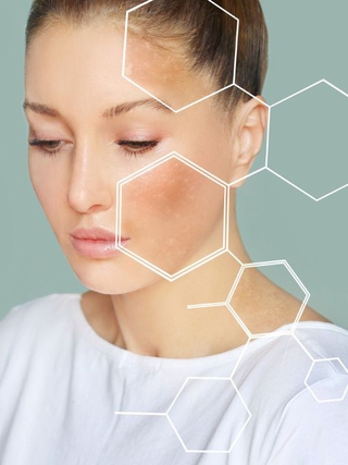 Cách phân biệt giữa tăng sắc tố và nám da để điều trị đúng