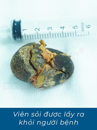 Phát hiện sỏi túi mật lớn gần bằng quả trứng gà khi khám sức khỏe định kỳ