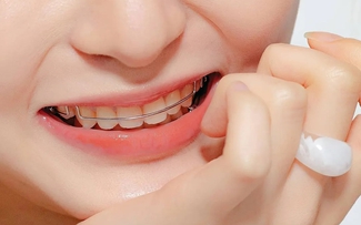 Chăm sóc hàm duy trì sau khi niềng răng hiệu quả nhất từ nha sĩ