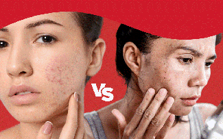 Hết thâm đỏ sau mụn nhanh: Cách chọn sản phẩm chuẩn khoa học