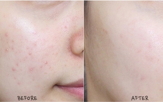 Top 4 sản phẩm trị mụn cấp tốc cho da nhạy cảm, dịu nhẹ không kích ứng